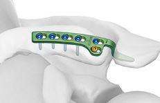 Ключична гачкова пластина ІІІ, ліва, гачок 18мм ( Double Medical Technology Inc.)